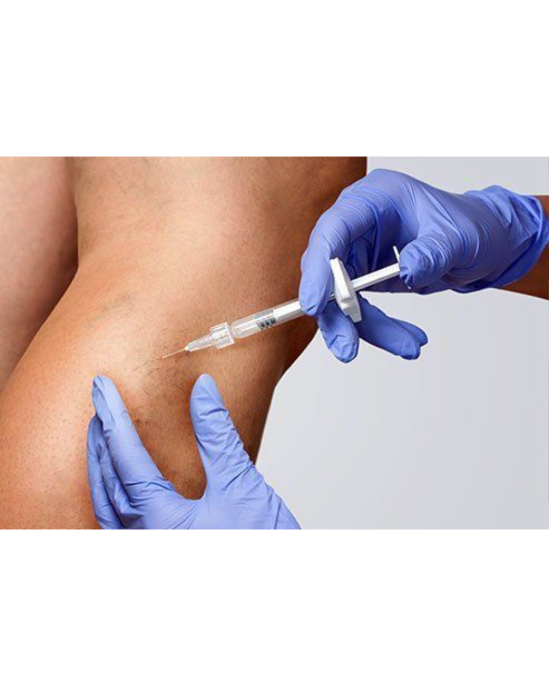 Tratamiento De Varices