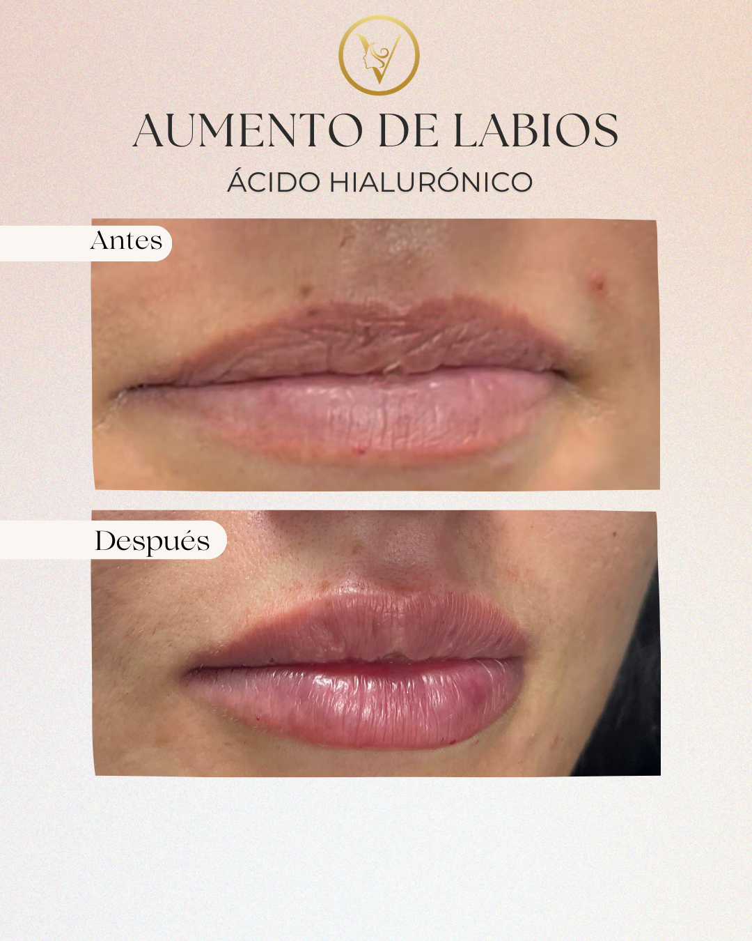 Aumento De Labios