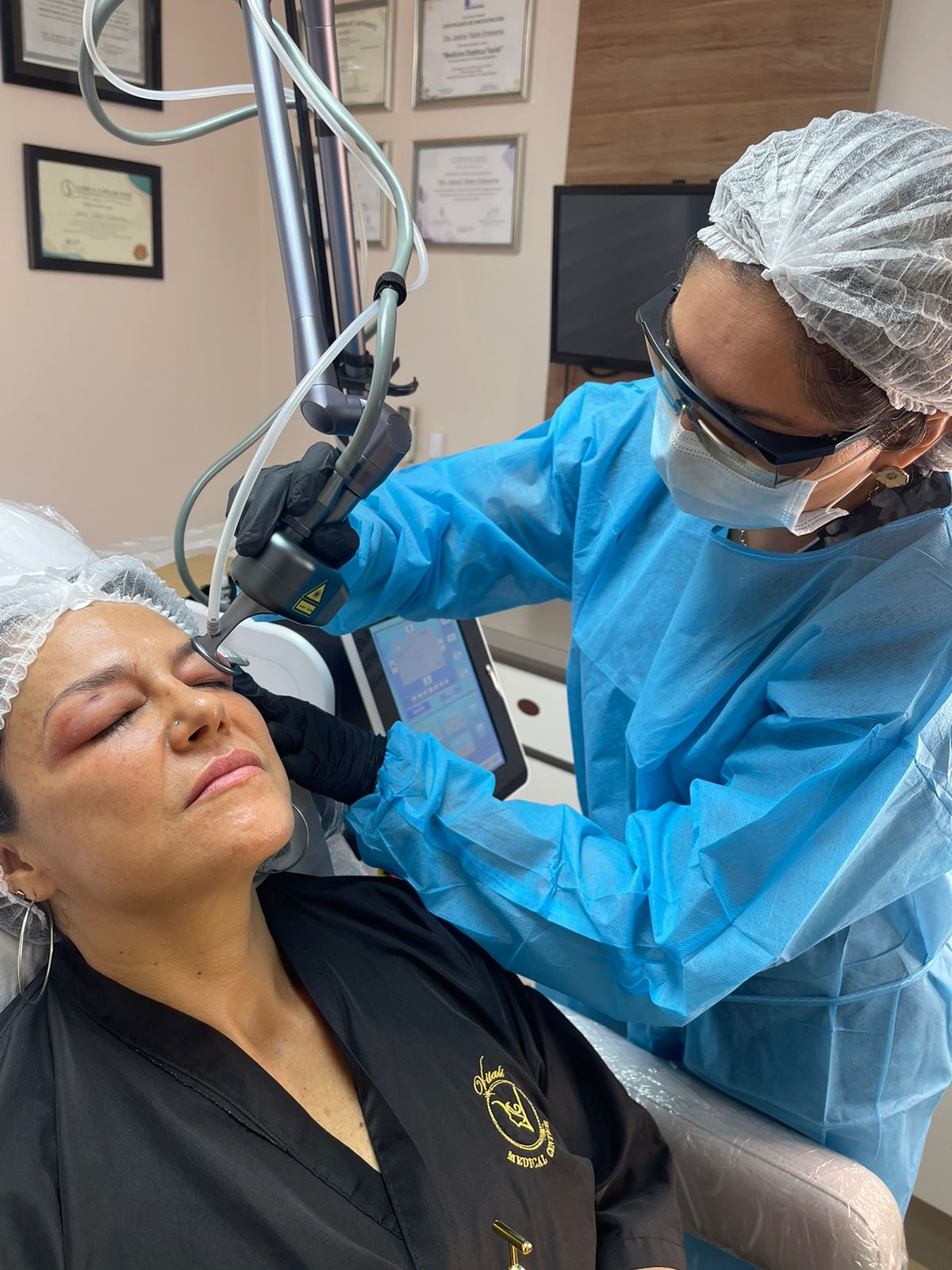 Laser Co2 Fraccionado